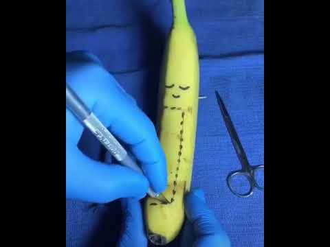 عمليه جراحيه توليد الموزه 1