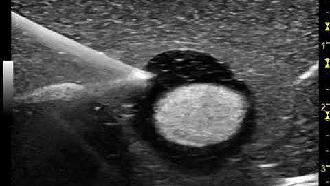 CytoCore Ultrasound Video: Phantom