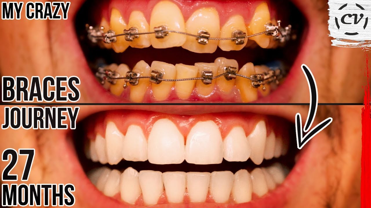 braces journey before and after