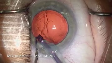 Cortical Cleaving Hydrodissection
