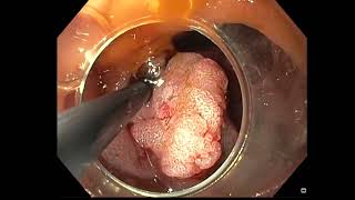 Duodenal EMR
