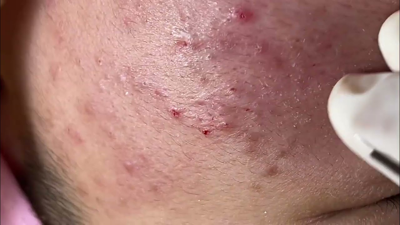 WOW !!! BLACKHEAD - Acne Treatment Mai Ngoc Da Nang