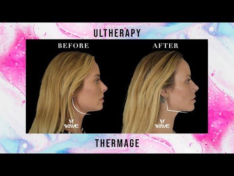 Ultherapy vs Thermage: Non Surgical Facelift with Collagen Stimulation | Wave Plastic Surgery