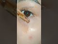 How to Treat Hyperpigmentation Naturally