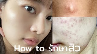 How to รักษาสิวด้วยตัวเอง ฉบับพักหน้า บอกหมดไม่กั๊ก! | mow!