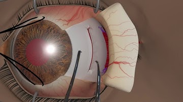 Strabismus surgery Recession