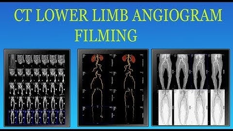 ct scan of  lower limb angiogram  filming