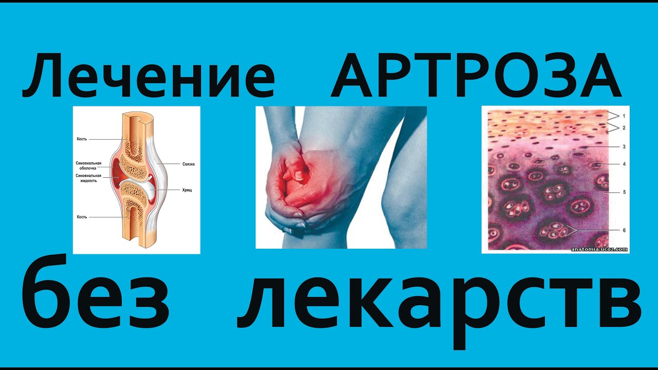 Как лечить АРТРОЗ и ОСТЕОХОНДРОЗ без лекарств. Ошибки при лечении - YouTube