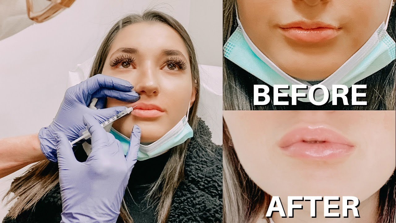 LIP FLIP VLOG (Daily Updates + Results)