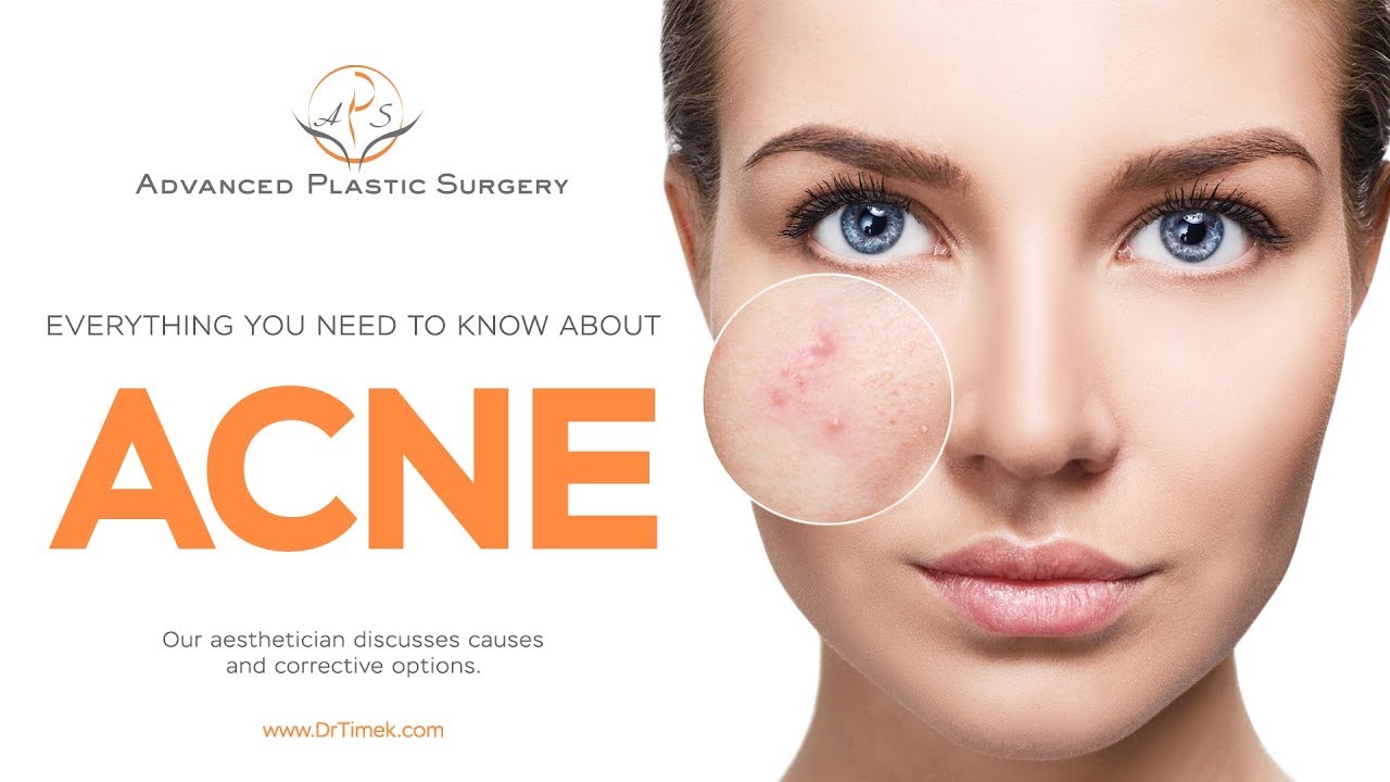 Everything You Need to Know about ACNE! - YouTube