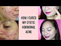 How I cured my cystic hormonal acne