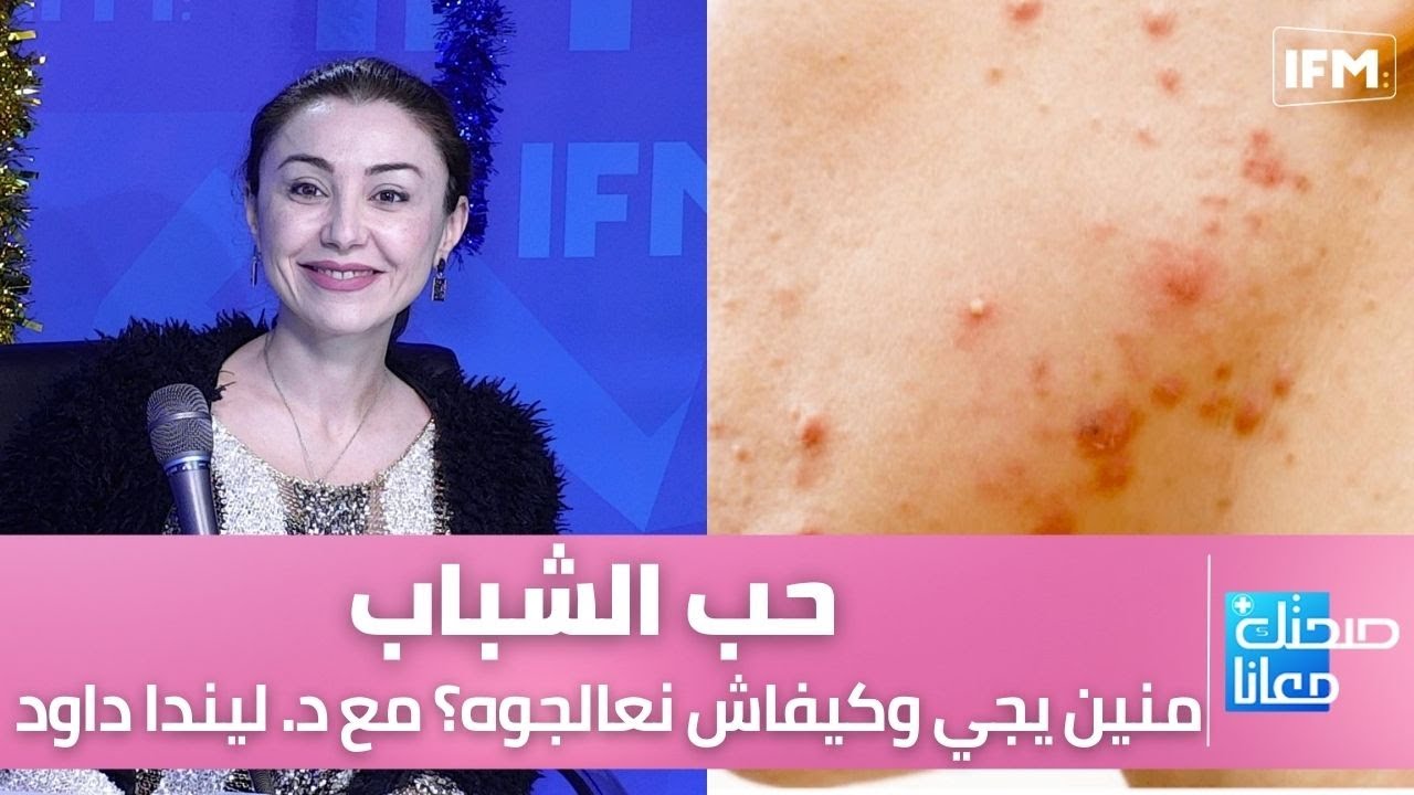 حب الشباب، منين يجي وكيفاش نعالجوه؟ مع د. ليندا داود