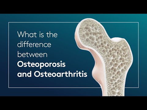 Videó: Különbség Az Osteoarthritis és Az Osteoporosis Között