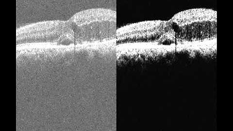 Geodesic Denoising for Optical Coherence Tomography Images