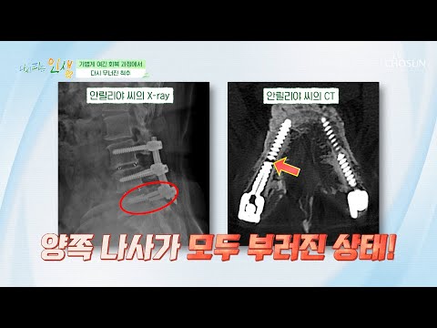 💥충격적인 검사 결과💥 무너져내린 척추와 부러진 나사😱 TV CHOSUN 230821 방송  | [다시피는 <strong>인생</strong>] 12회 | TV조선
