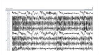 EEG Atlas B1: Recognize Common Artifacts Seen on EEG Using The Ceribell Rapid Response System