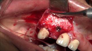 Extraction & Immidiate Implant Placement Using Bone Graft & Membrane(Single Tooth Extraction & Immediate Implantation. Because Of Very Thin Buccal Bone We put Bone Graft And Membrane. Fixed By BioHorizons Autotac Kit., 2015-05-12T14:41:37.000Z)