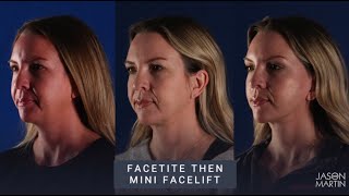 Facetite vs. Mini Facelift or Both!