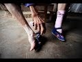 【衝撃】纏足(てんそく)された女性の足がマジで痛々しい!【閲覧注意】