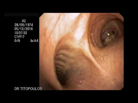 Καρκινοειδές Βρόγχου (Bronchial carcinoid neuroendocrine tumor)