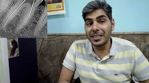 Endodontic Flare up Management