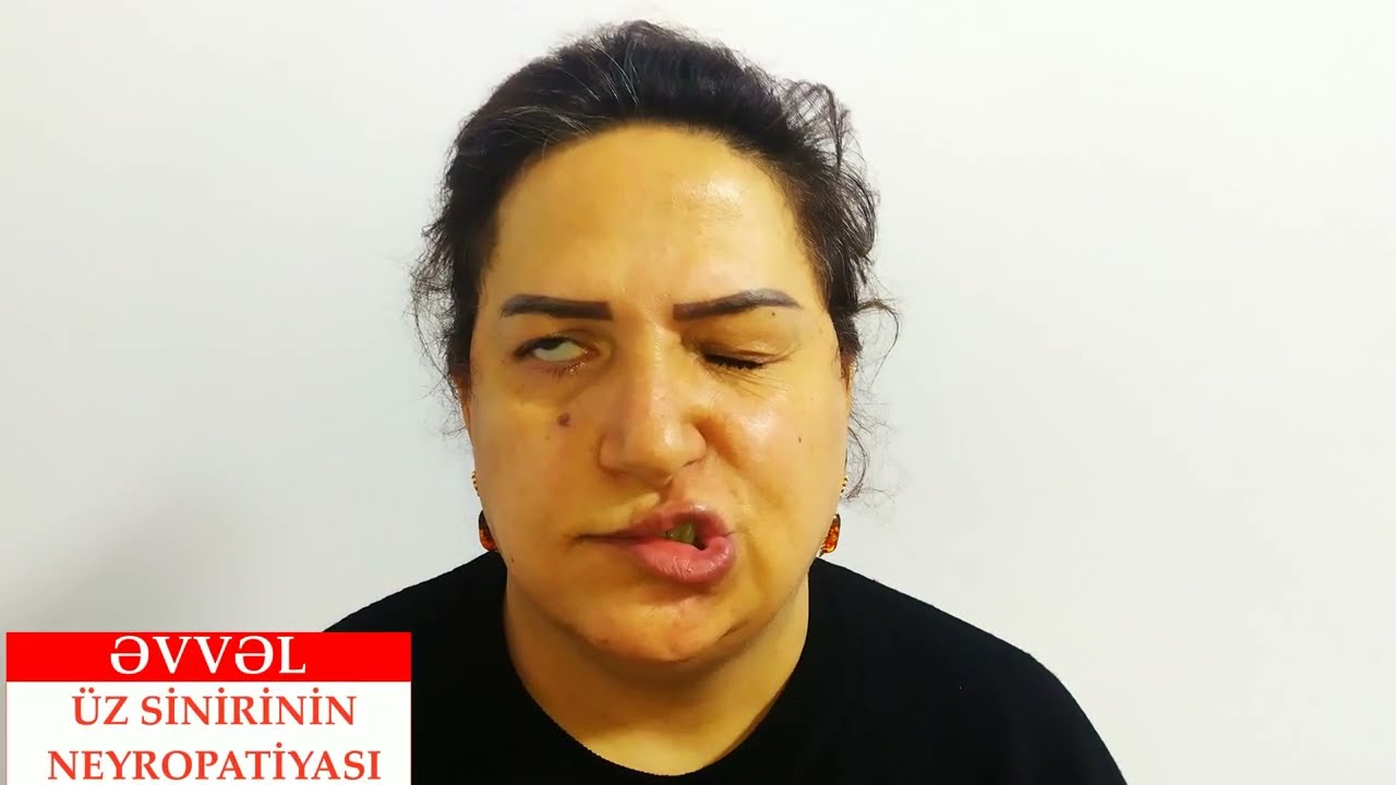 Sağ Üz Sinirinin Neyropatiyası (Gülər xanım) - TAM NƏTİCƏ (ƏVVƏL-SONRA)