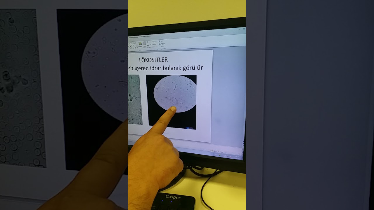 idrar mikroskobisinde neler görülür #idrarmikroskobisi