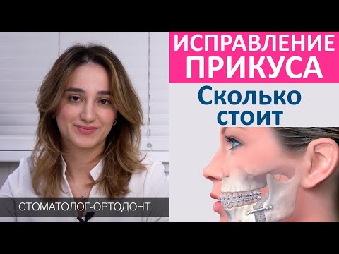 Исправление прикуса: стоимость лечения, брекеты или элайнеры. Что влияет на цену лечения