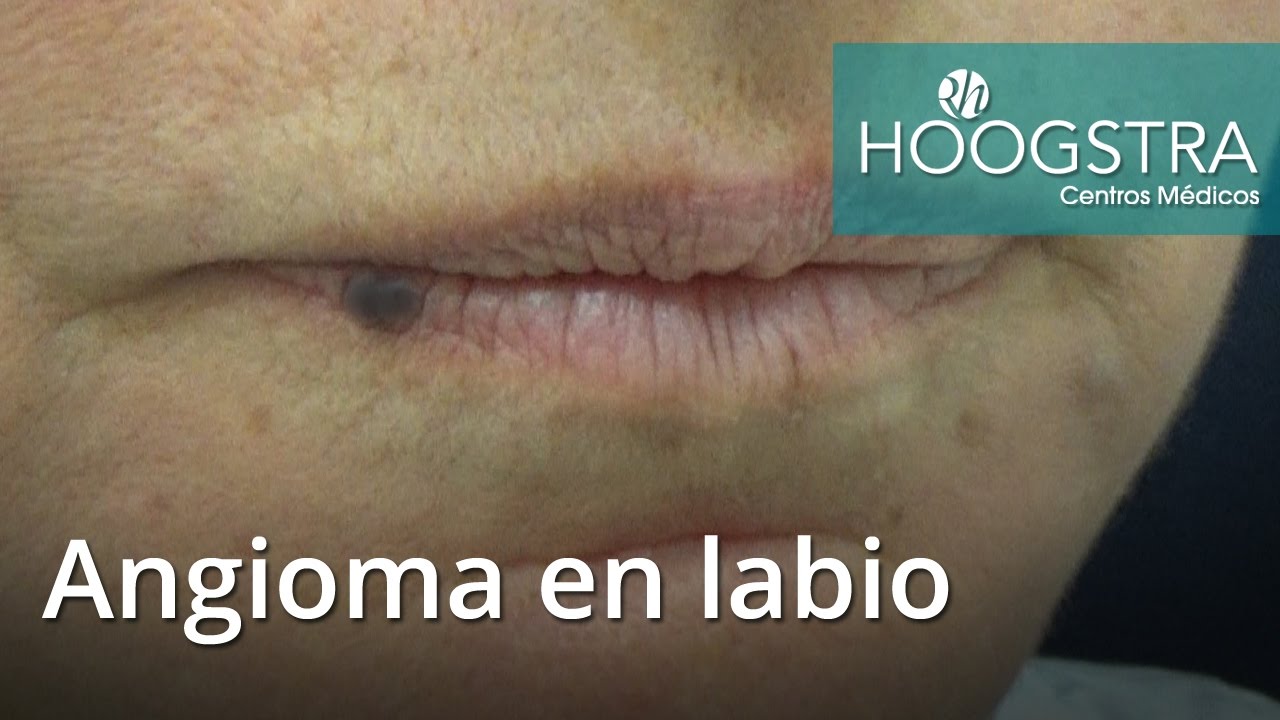 hemangioma labio inferior