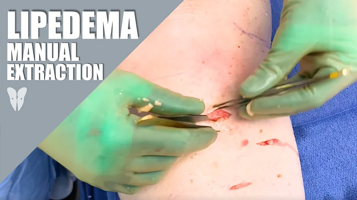 Manual Lipedema Extraction | Dr. Jaime Schwartz | ...
