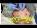 Massive Face Cyst Removal. Dr Khaled Sadek. LipomaCyst.com