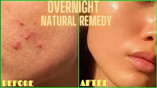 HOW TO GET RID OF ACNE, PIMPLES, BUMPS ON FACE OVERNIGHT | Simple Home Remedy (DIY Lemon Treatment) screenshot 5