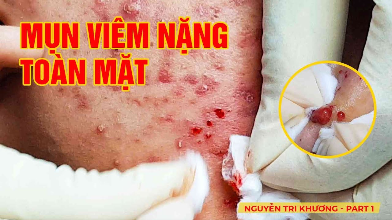 HHV Clinic | Đỗ Thu Hiền | Nguyen Tri Phuong - Part 1