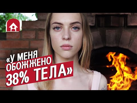 Девушка с ожогами: Даша | Быть молодым