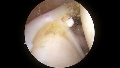 SLAP Tear of the Shoulder: Explained