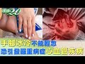 手腳冰冷不能輕忽 恐引發嚴重病症心血管疾病 健康2.0