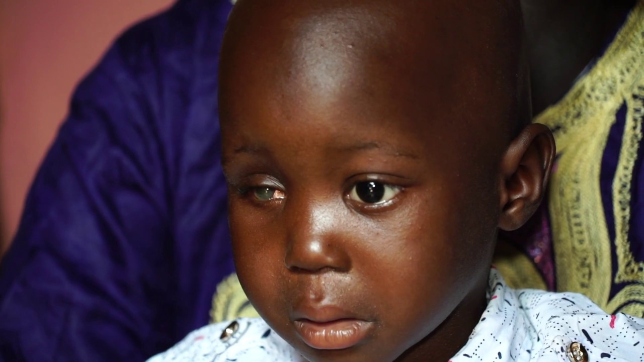 mali des enfants victimes d une tumeur des yeux uccadia