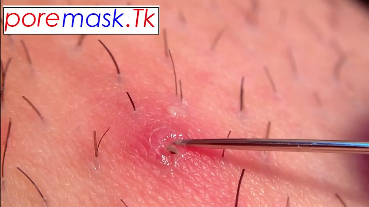 Ingrown Hair On Penis