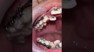 DENTAL BRACES VS DIY BRACES #dentist