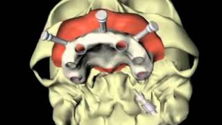 teeth in an hour mp4