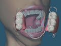 Reposição com prótese removível com grampo e sem grampo nas ausências dentárias - Vídeo 02