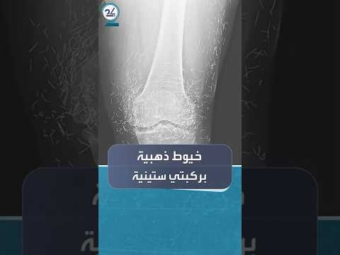 أطباء يكتشفون خيوطا ذهبية مزروعة بركبتي سيدة ستينية