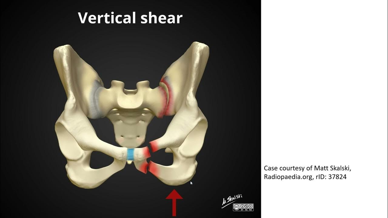 Pelvic bucket handle fracture YouTube