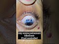 secondry Glucoma #visioncaremeerut