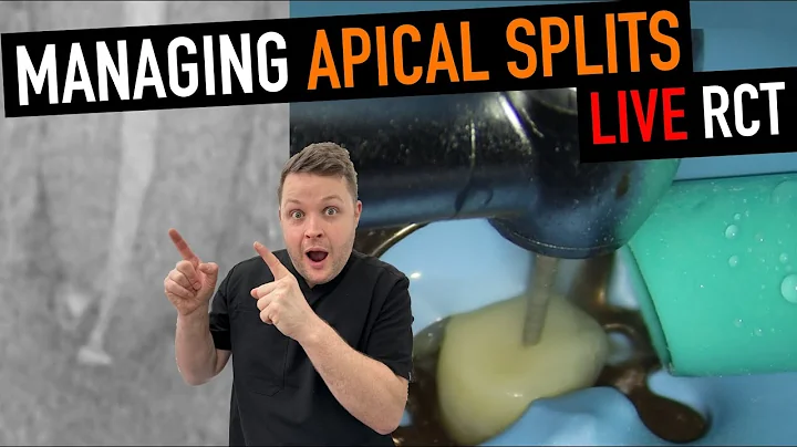 T-Mode Magic! Deep Apical Split & Ledge Bypass in Lower Premolar