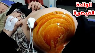 شاهد عملية الولادة القيصرية كاملة | Watch the caesarean section 3D animation