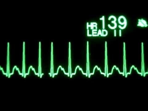 ვიდეო: გულისცემის ცვალებადობა, როგორც ინფარქტის მქონე პირებში გულის შეტევის რისკის პოტენციური მაჩვენებელი