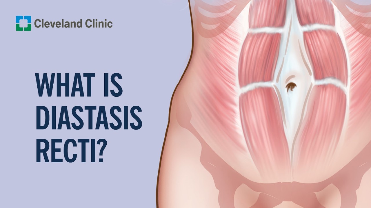 Understanding Diastasis Recti: Causes, Self-Check, and Treatment