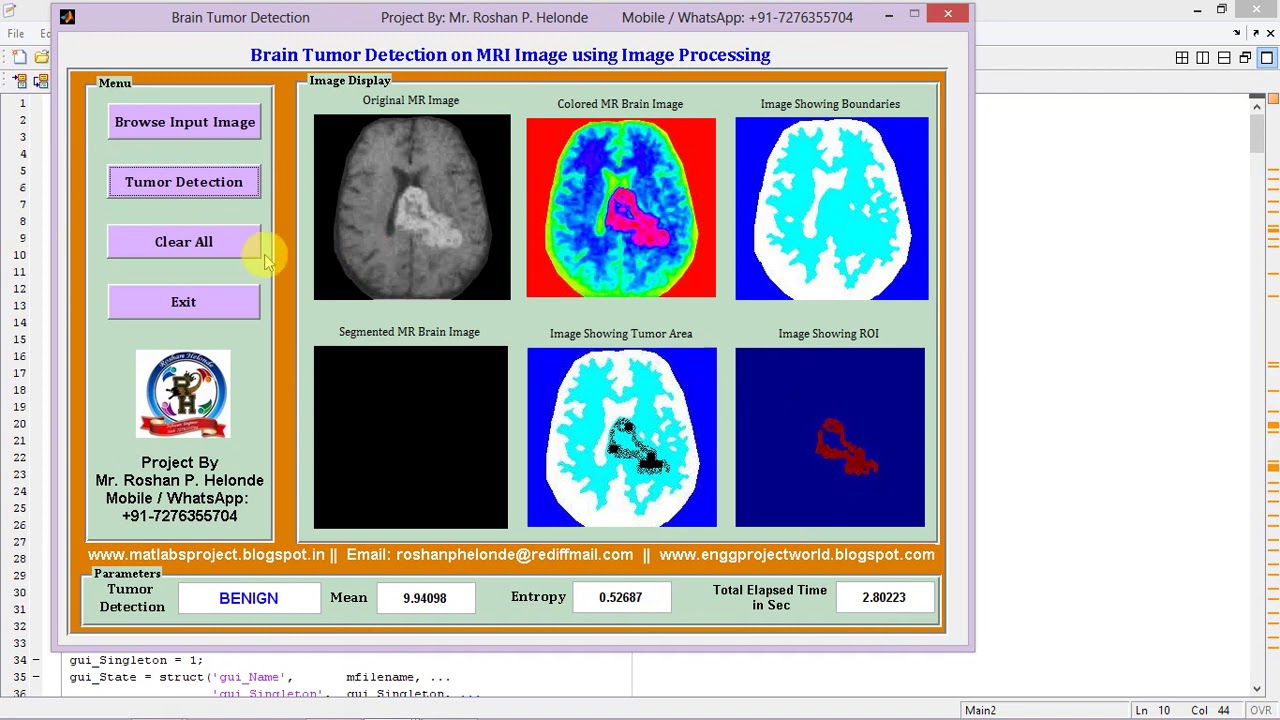 Brain Tumor Detection and Classification Full Matlab Project Code - YouTube