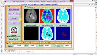 Brain Tumor Detection and Classification Full Matlab Project Code